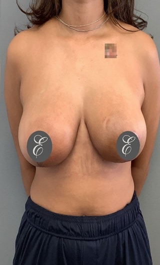 After Image: Breast Lift - front