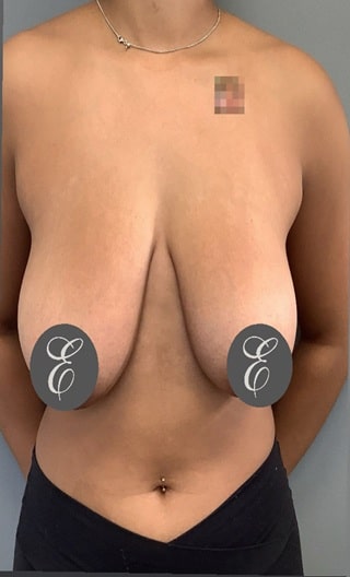 Before Image: Breast Lift - front