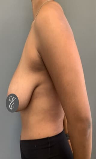 Before Image: Breast Lift - left-side