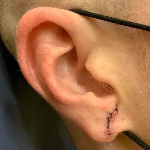 After Image: Earlobe Repair/Reduction - right-side