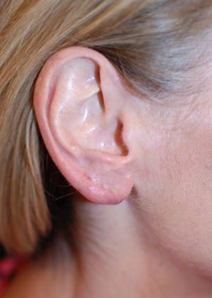 After Image: Earlobe Repair/Reduction - right-side