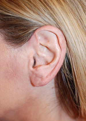 After Image: Earlobe Repair/Reduction - left-side