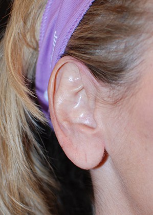 Before Image: Earlobe Repair/Reduction - right-side