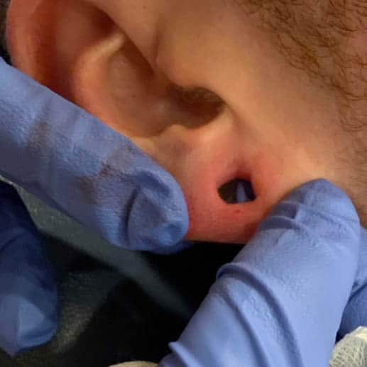 Before Image: Earlobe Repair/Reduction - right-side