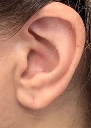 After Image: Earlobe Repair/Reduction - left-side
