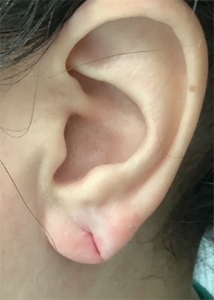 Before Image: Earlobe Repair/Reduction - left-side