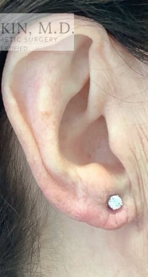 After Image: Earlobe Repair/Reduction - right-side