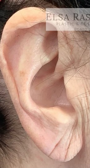 Before Image: Earlobe Repair/Reduction - right-side