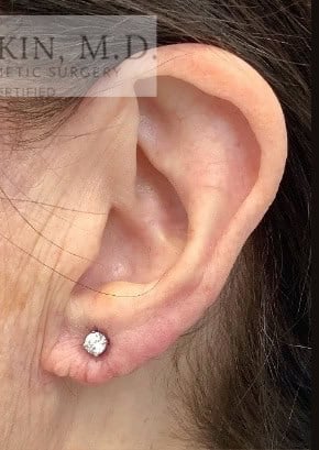 After Image: Earlobe Repair/Reduction - left-side