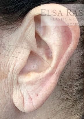 Before Image: Earlobe Repair/Reduction - left-side