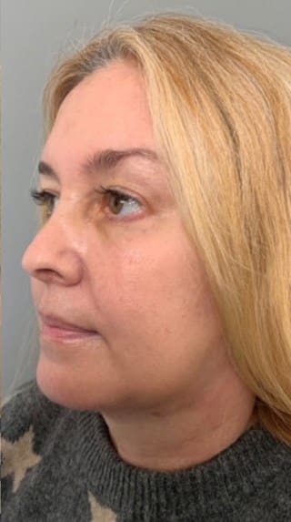 After Image: Facelift - left-front-oblique