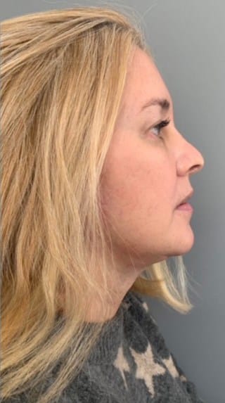 After Image: Facelift - right-side