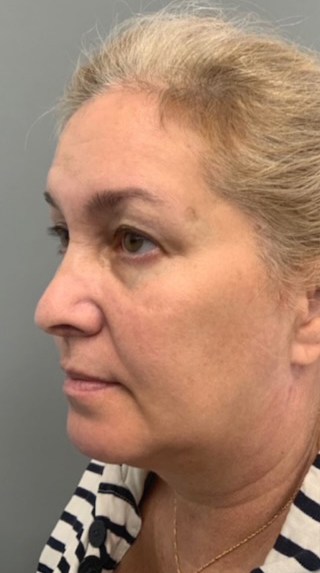 Before Image: Facelift - left-front-oblique