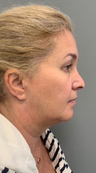 Before Image: Facelift - right-side