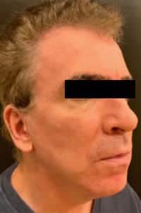 After Image: Facelift - right-side