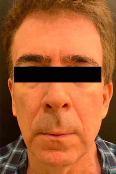 Before Image: Facelift - front
