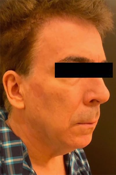 Before Image: Facelift - right-side