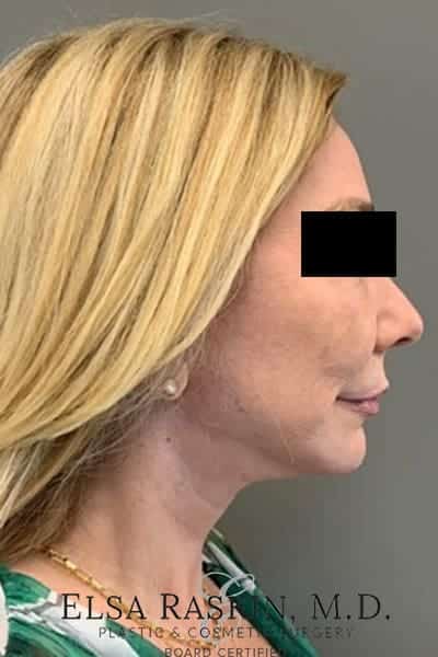After Image: Facelift - right-side