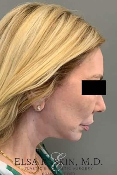After Image: Facelift - right-side