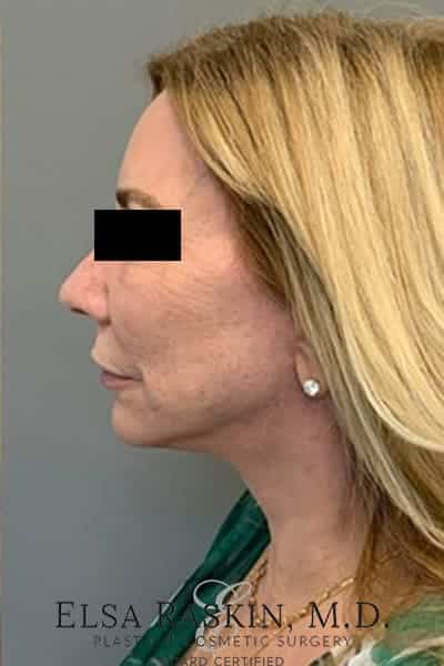 After Image: Facelift - left-side