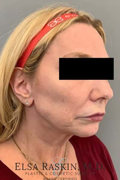 Before Image: Facelift - right-front-oblique