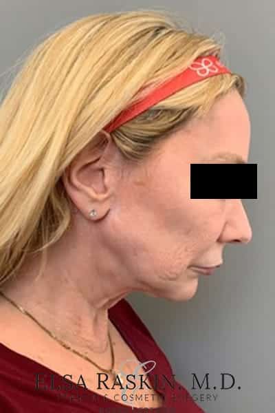Before Image: Facelift - right-side