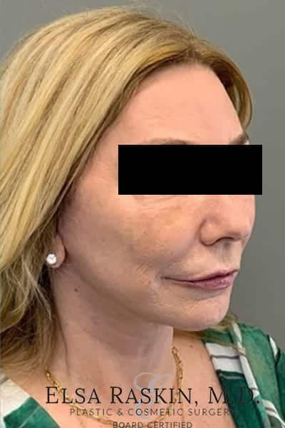 After Image: Neck Lift - right-front-oblique