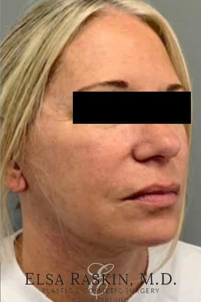 After Image: Facelift - right-front-oblique