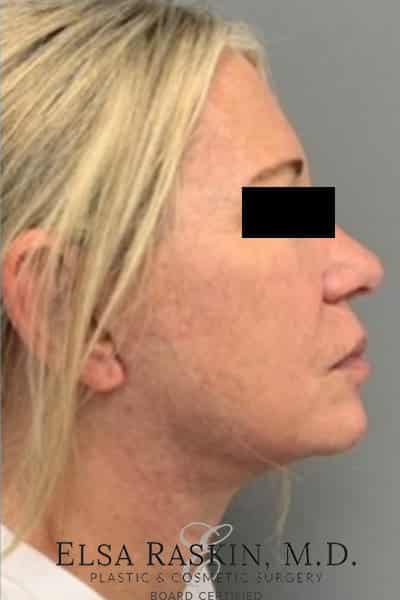 After Image: Facelift - right-side