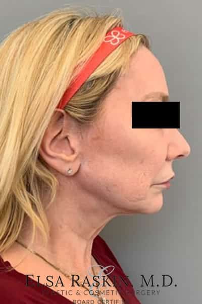 Before Image: Neck Lift - right-side