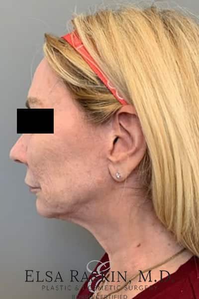 Before Image: Neck Lift - left-side