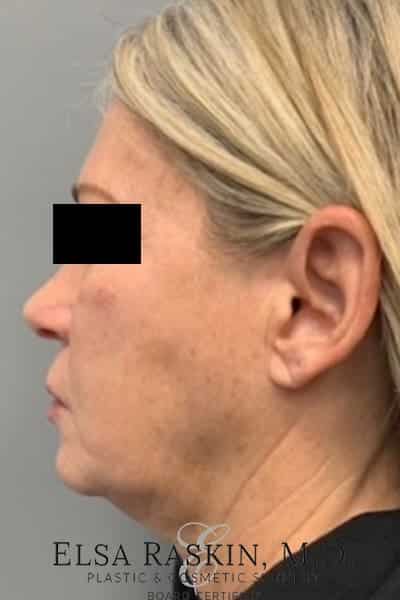 Before Image: Facelift - left-side