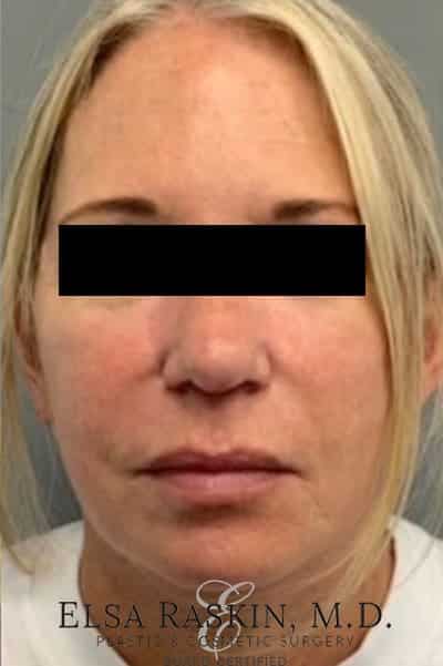 After Image: Neck Lift - front