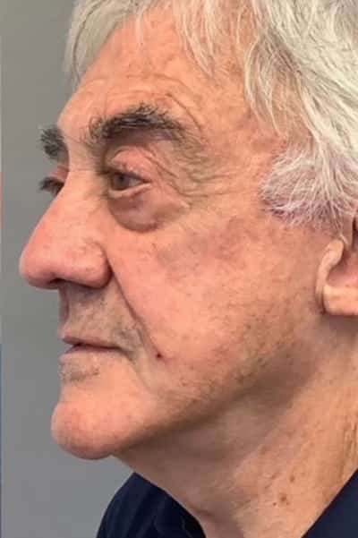 After Image: Facelift - left-front-oblique