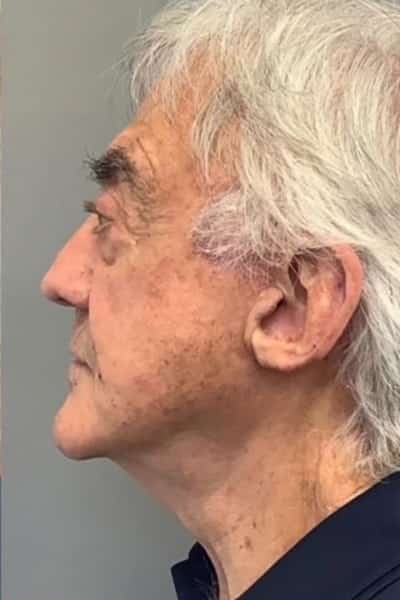 After Image: Facelift - left-side