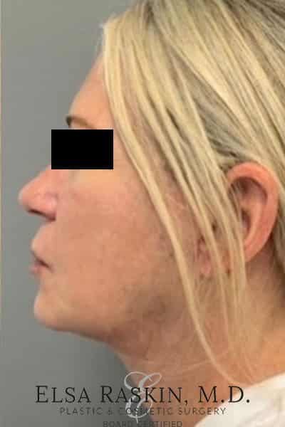 After Image: Neck Lift - left-side