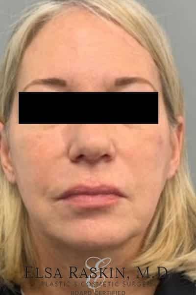 Before Image: Neck Lift - front
