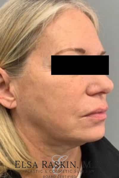 Before Image: Neck Lift - right-front-oblique