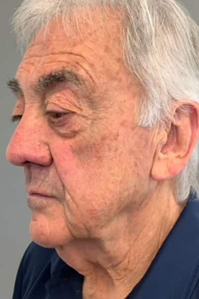 Before Image: Facelift - left-front-oblique
