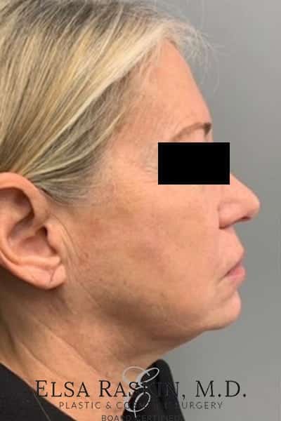 Before Image: Neck Lift - right-side