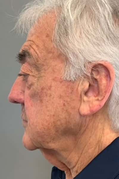 Before Image: Facelift - left-side