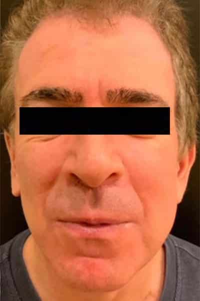 After Image: Neck Lift - front