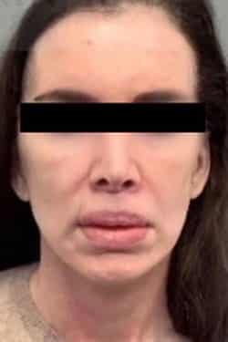 After Image: Facelift - front