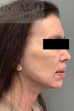 After Image: Facelift - right-side
