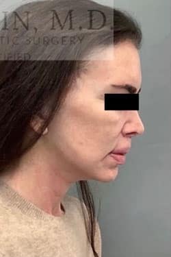 After Image: Facelift - right-side