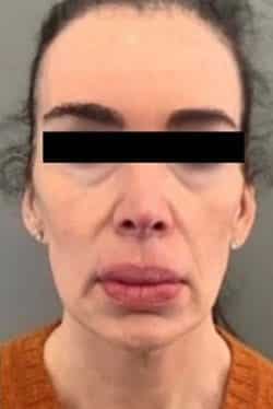 Before Image: Facelift - front