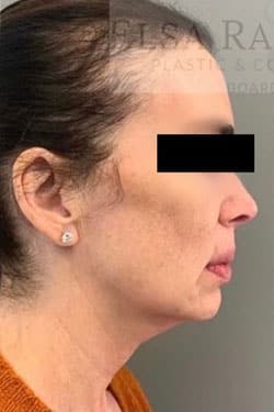 Before Image: Facelift - right-side