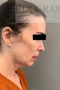 Before Image: Facelift - right-side