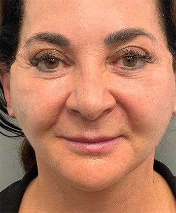 After Image: Facelift - front