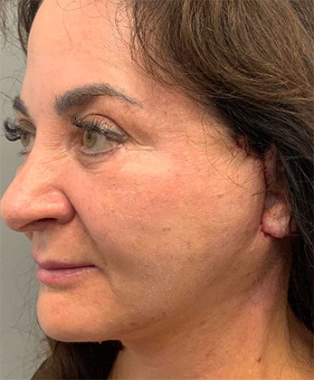After Image: Facelift - left-front-oblique
